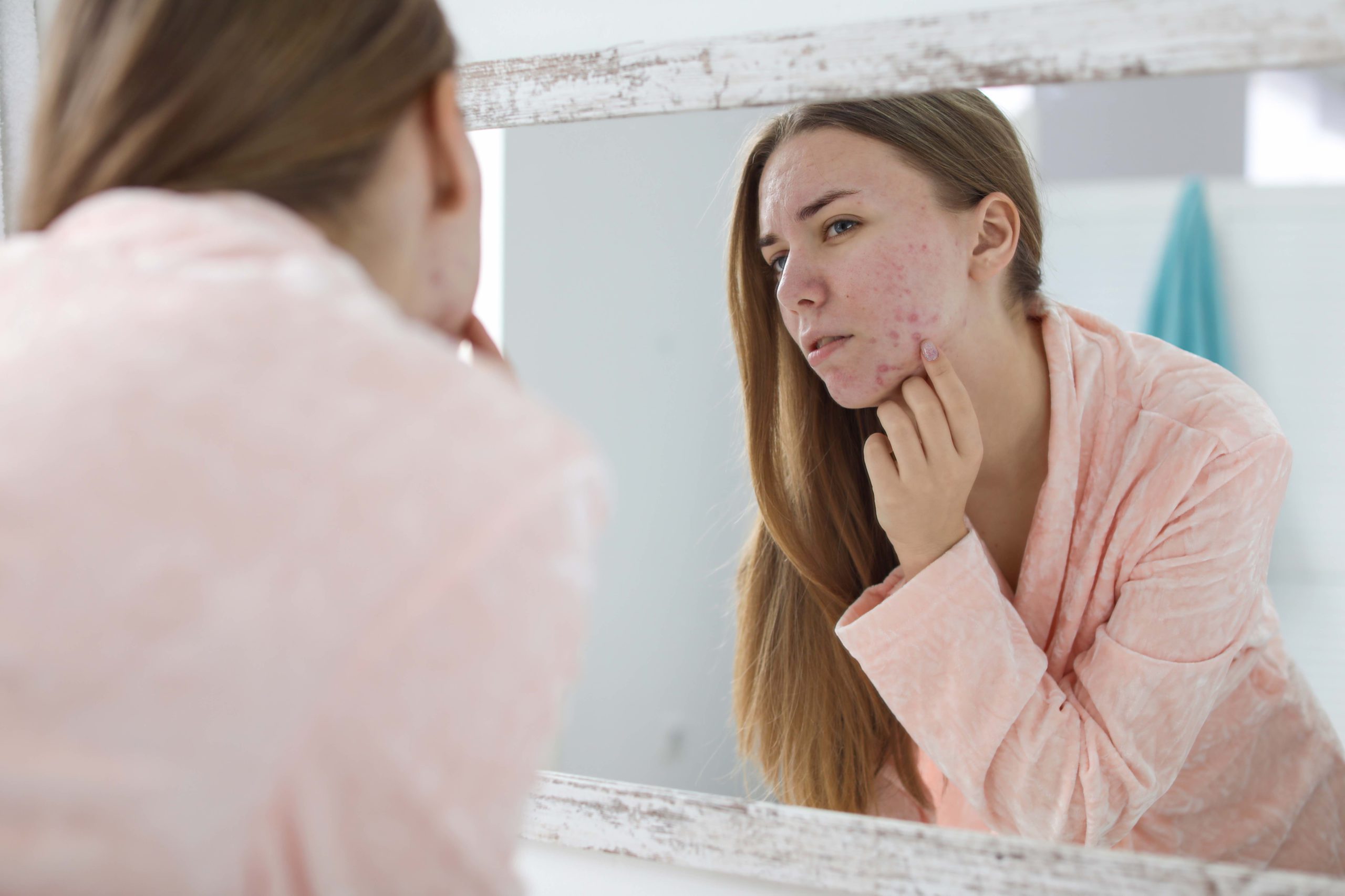 Acne Causes, Prevention, and Treatment