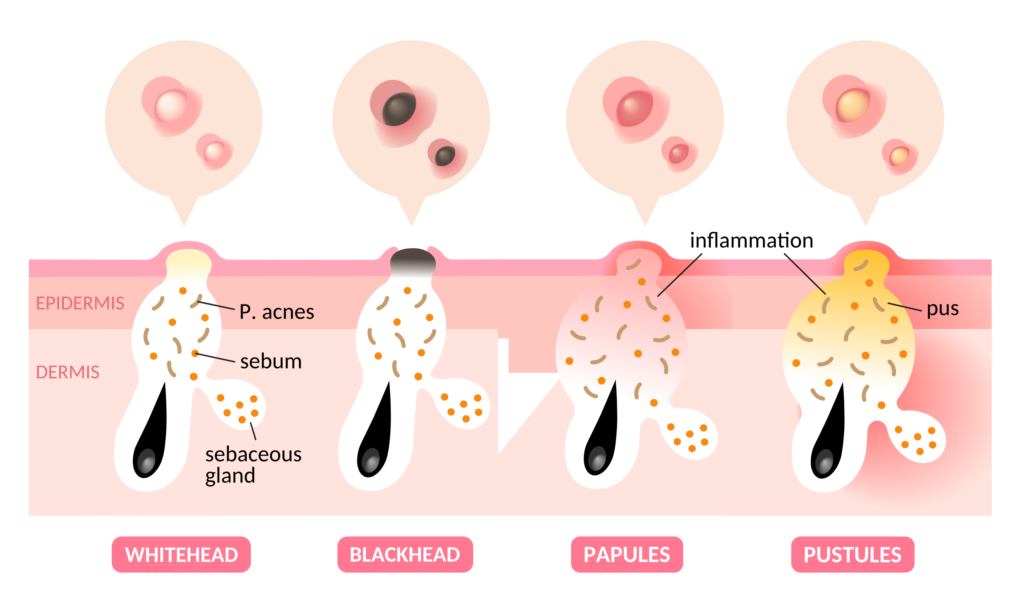 The different types of acne and what they look like underneath the skin